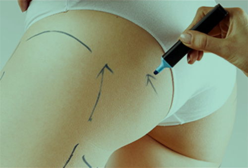 Gluteoplastia