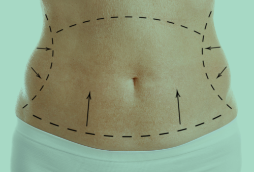 abdominoplastia 2